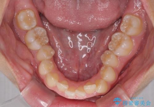 【モニター】前歯のデコボコと変色した前歯をインビザラインとオールセラミッククラウンでの治療前