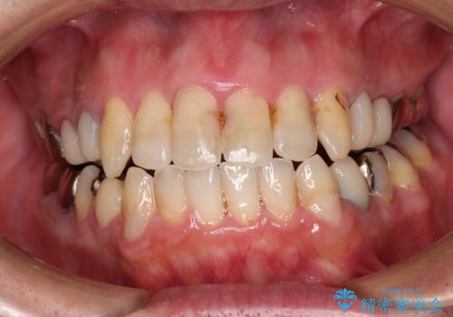 飛び出した前歯と目立つ銀歯 矯正とセラミックの総合歯科診療の治療中