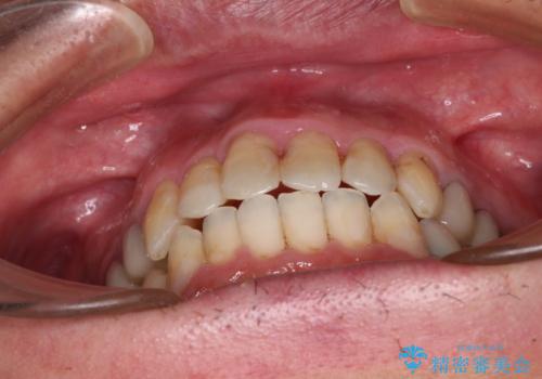 飛び出した前歯と目立つ銀歯 矯正とセラミックの総合歯科診療の治療中