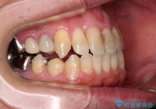 飛び出した前歯と目立つ銀歯 矯正とセラミックの総合歯科診療の治療中
