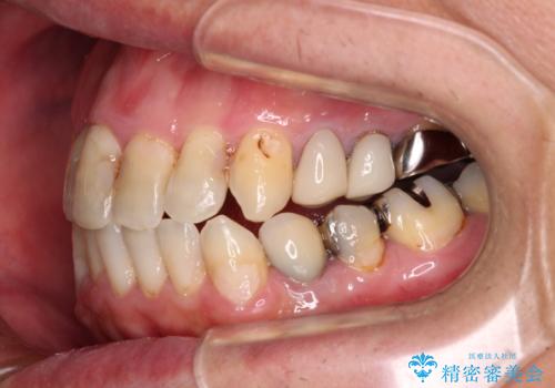 飛び出した前歯と目立つ銀歯 矯正とセラミックの総合歯科診療の治療中