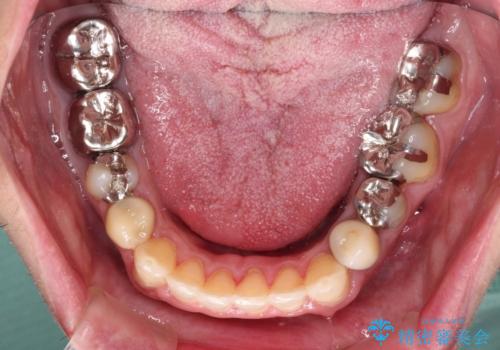 飛び出した前歯と目立つ銀歯 矯正とセラミックの総合歯科診療の治療中