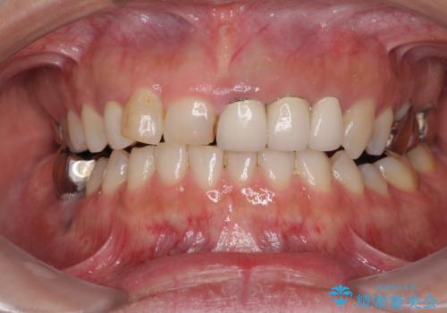 歯が全く咬みあわない　矯正と補綴の全顎治療の症例 治療前