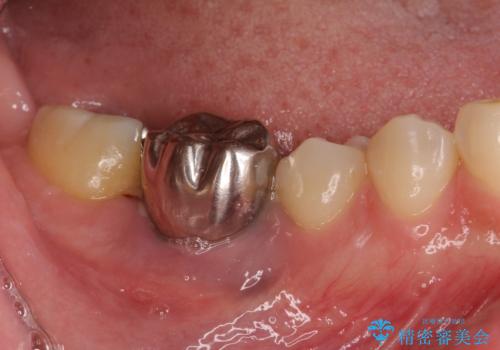 歯が全く咬みあわない 矯正と補綴の全顎治療の治療前