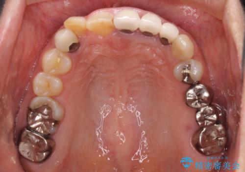 歯が全く咬みあわない 矯正と補綴の全顎治療の治療前