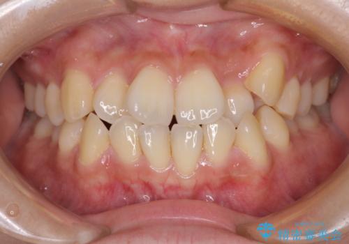 前歯のデコボコを改善　ワイヤー矯正を併用したインビザライン矯正の症例 治療前