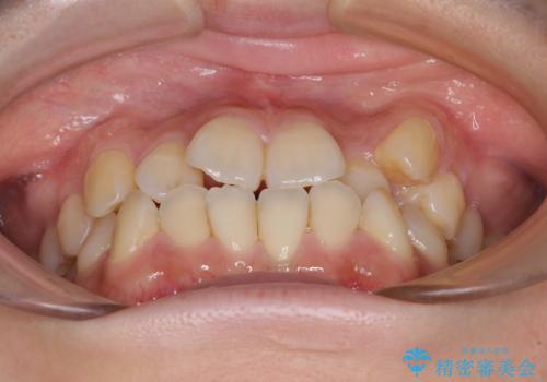 前歯のデコボコを改善　ワイヤー矯正を併用したインビザライン矯正の治療前