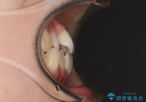 【モニター】前歯のデコボコを改善 ワイヤー矯正を併用したインビザライン矯正の治療前