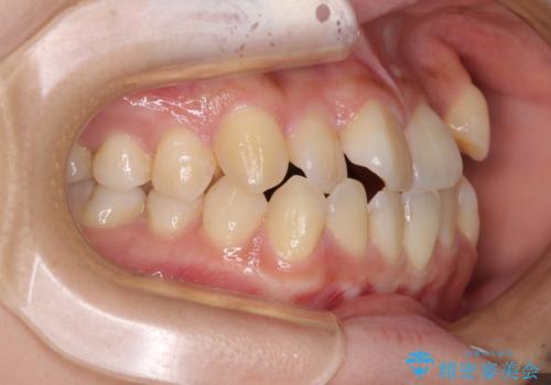 前歯のデコボコを改善　ワイヤー矯正を併用したインビザライン矯正の治療前
