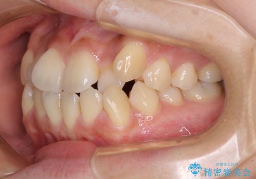 【モニター】前歯のデコボコを改善　ワイヤー矯正を併用したインビザライン矯正の治療前