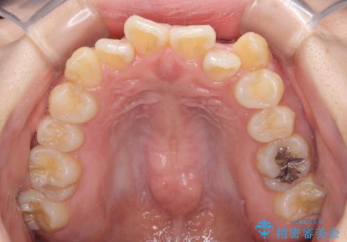 【モニター】前歯のデコボコを改善 ワイヤー矯正を併用したインビザライン矯正の治療前