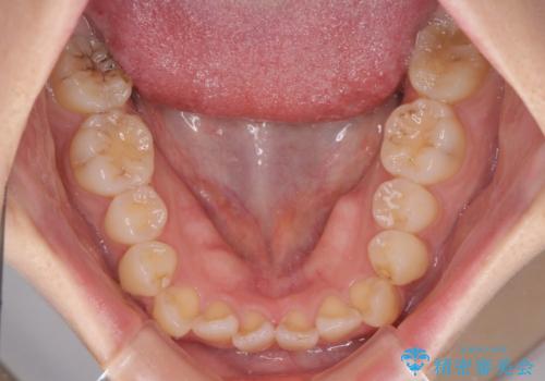 【モニター】前歯のデコボコを改善 ワイヤー矯正を併用したインビザライン矯正の治療前
