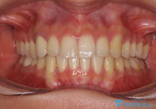 【モニター】下顎の気になる八重歯を改善 インビザラインによる矯正治療の症例 治療後