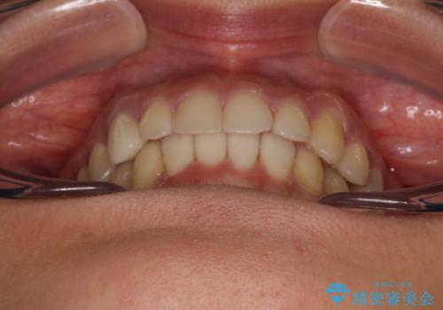 【モニター】下顎の気になる八重歯を改善 インビザラインによる矯正治療の治療後