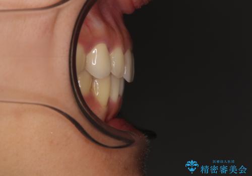 【モニター】下顎の気になる八重歯を改善 インビザラインによる矯正治療の治療後