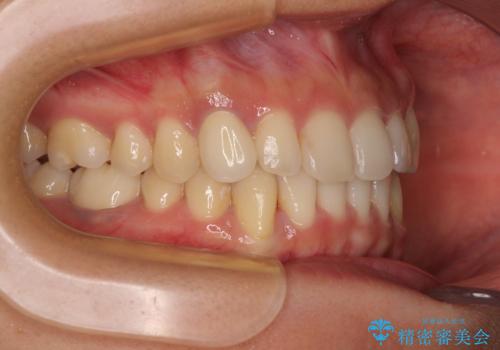 【モニター】下顎の気になる八重歯を改善 インビザラインによる矯正治療の治療後