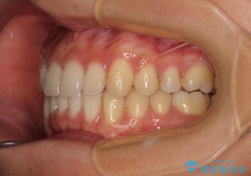 【モニター】下顎の気になる八重歯を改善 インビザラインによる矯正治療の治療後