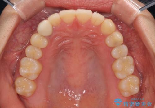 【モニター】下顎の気になる八重歯を改善 インビザラインによる矯正治療の治療後