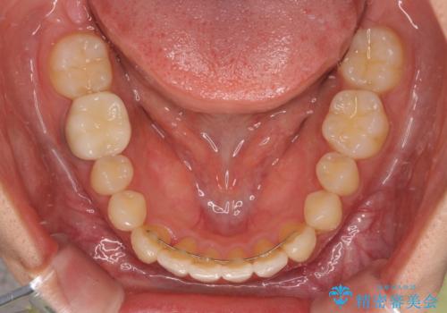 【モニター】下顎の気になる八重歯を改善 インビザラインによる矯正治療の治療後