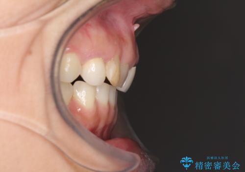 歯が全く咬みあわない 矯正と補綴の全顎治療の治療前