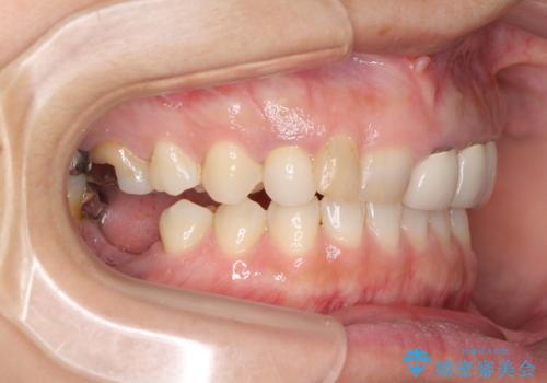 歯が全く咬みあわない 矯正と補綴の全顎治療の治療前