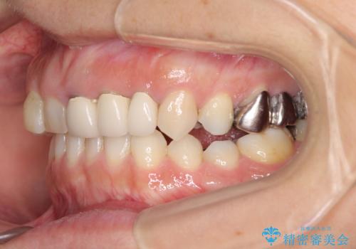 歯が全く咬みあわない 矯正と補綴の全顎治療の治療前
