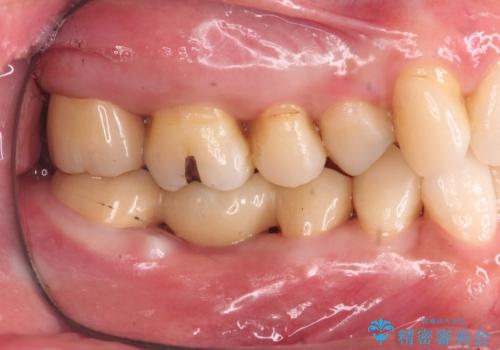 他院で奥歯の初めての根の治療を10回以上通った上に抜歯と言われた　歯茎が腫れて痛いの症例 治療後