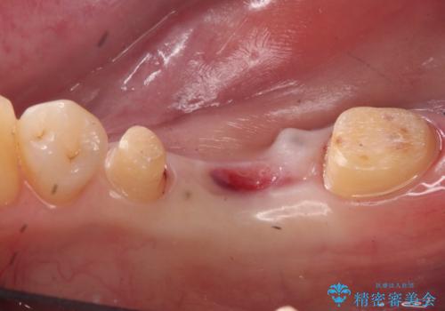他院で奥歯の初めての根の治療を10回以上通った上に抜歯と言われた　歯茎が腫れて痛いの治療中