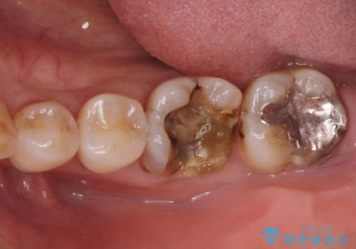 銀歯が取れた。の治療前