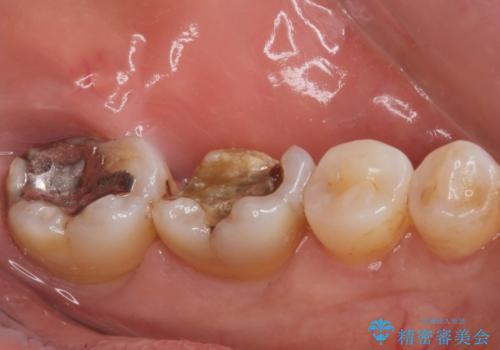 銀歯が取れた。の治療前