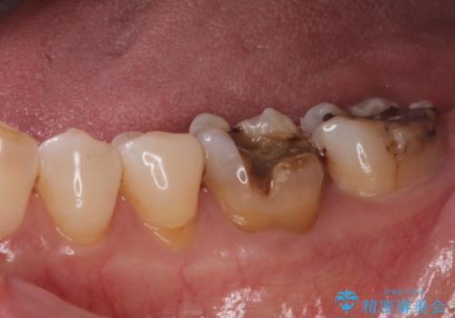 銀歯が取れた。の治療前