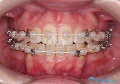 上下非接触で突出した前歯 ワイヤー装置による抜歯矯正の治療中