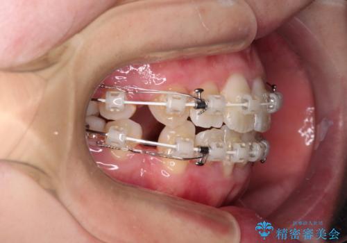 上下非接触で突出した前歯 ワイヤー装置による抜歯矯正の治療中