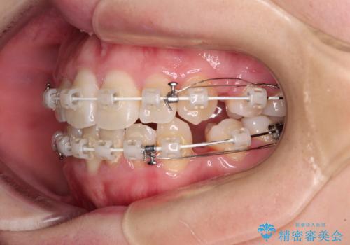 上下非接触で突出した前歯 ワイヤー装置による抜歯矯正の治療中