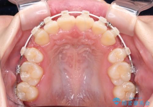 上下非接触で突出した前歯　ワイヤー装置による抜歯矯正の治療中