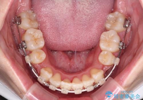 上下非接触で突出した前歯　ワイヤー装置による抜歯矯正の治療中