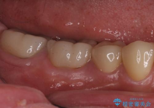 樹脂で継ぎ接ぎになった歯 セラミッククラウンでの治療の治療後