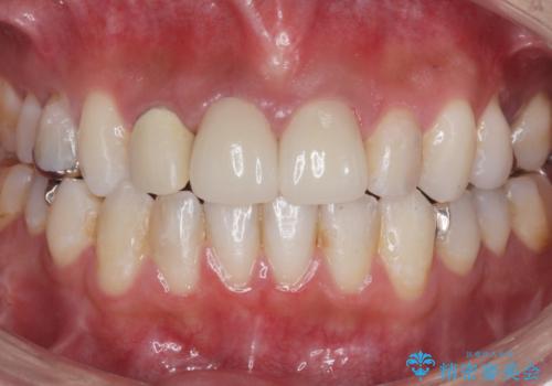 前歯が取れたの治療後