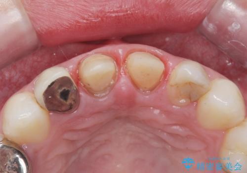 前歯が取れたの治療中