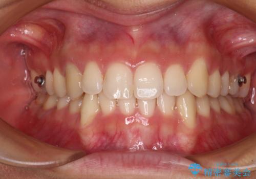 【モニター】下顎の気になる八重歯を改善 インビザラインによる矯正治療の治療中