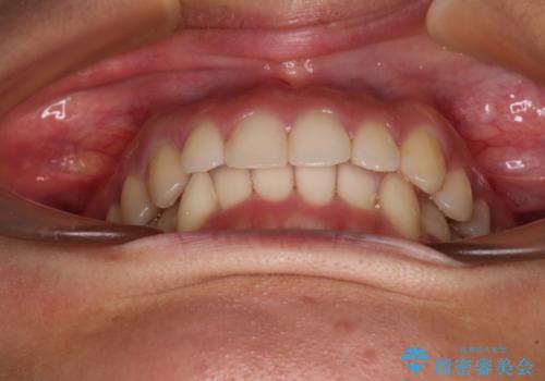 【モニター】下顎の気になる八重歯を改善　インビザラインによる矯正治療の治療中
