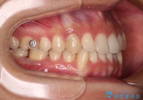 【モニター】下顎の気になる八重歯を改善 インビザラインによる矯正治療の治療中