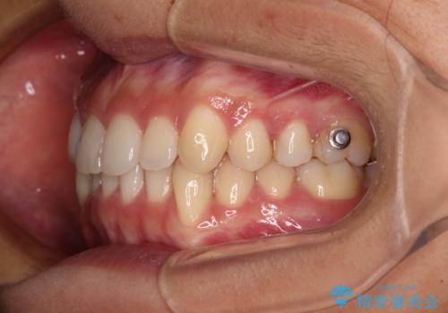 【モニター】下顎の気になる八重歯を改善 インビザラインによる矯正治療の治療中