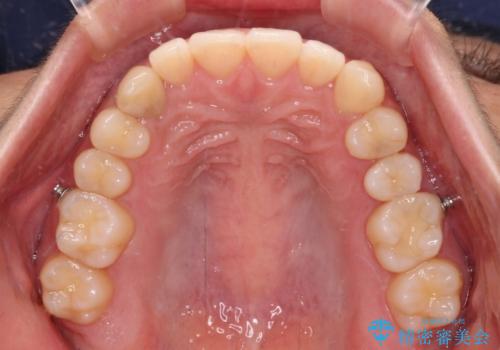 【モニター】下顎の気になる八重歯を改善 インビザラインによる矯正治療の治療中