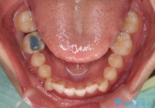 【モニター】下顎の気になる八重歯を改善 インビザラインによる矯正治療の治療中