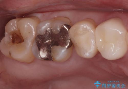 奥の歯に穴が空いているの症例 治療前