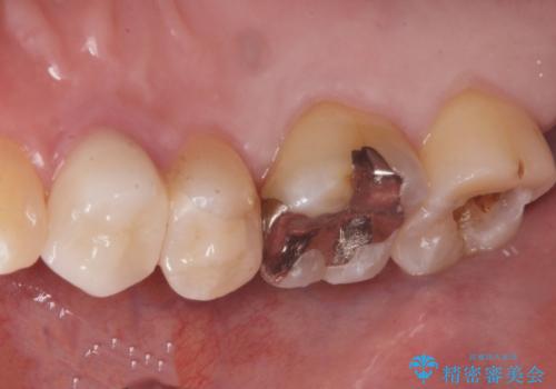 奥の歯に穴が空いているの治療前