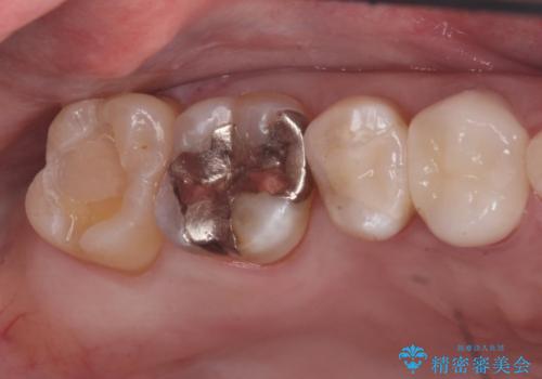 奥の歯に穴が空いているの治療中