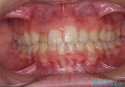 【モニター】前歯のデコボコと変色した前歯をインビザラインとオールセラミッククラウンでの治療中