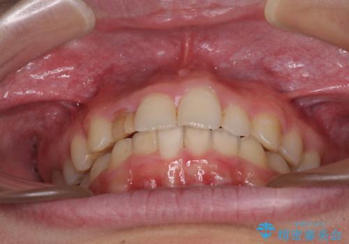 【モニター】前歯のデコボコと変色した前歯をインビザラインとオールセラミッククラウンでの治療中